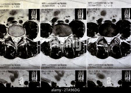 IRM rachis lombo-sacré sans produit de contraste a révélé un spasme musculaire du dos, de légères lésions discales L3-L4, L4-L5, hémangiome des vertèbres sacrées, L5 et T12, Banque D'Images