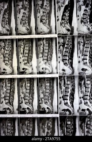 IRM rachis lombo-sacré sans produit de contraste a révélé un spasme musculaire du dos, de légères lésions discales L3-L4, L4-L5, hémangiome des vertèbres sacrées, L5 et T12, Banque D'Images