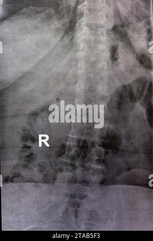 Une radiographie simple de la colonne vertébrale dorsale et lombaire révèle des modifications spondylotiques, un redressement de la colonne dorsale et lombaire, des espaces discaux intervertébraux intacts, Banque D'Images