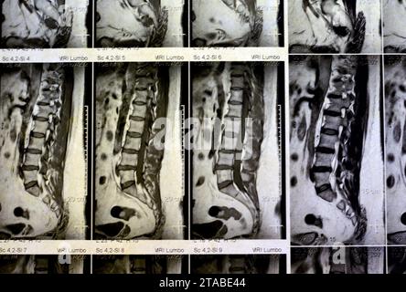 IRM rachis lombo-sacré sans produit de contraste a révélé un spasme musculaire du dos, de légères lésions discales L3-L4, L4-L5, hémangiome des vertèbres sacrées, L5 et T12, Banque D'Images