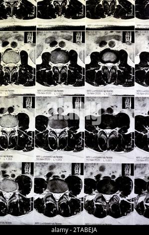 IRM rachis lombo-sacré sans produit de contraste a révélé un spasme musculaire du dos, de légères lésions discales L3-L4, L4-L5, hémangiome des vertèbres sacrées, L5 et T12, Banque D'Images