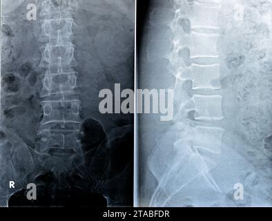 La radiographie simple du rachis lombo-sacré a révélé une légère déformation scoliotique redressée du rachis lombaire, des modifications spondylotiques, une sacro-iliite bilatérale, un narr léger Banque D'Images