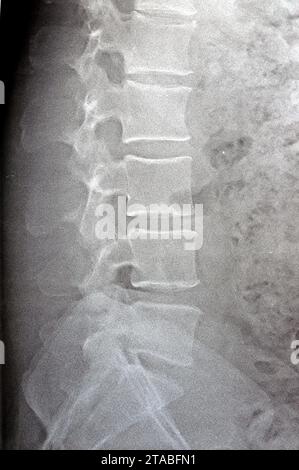 La radiographie simple du rachis lombo-sacré a révélé une légère déformation scoliotique redressée du rachis lombaire, des modifications spondylotiques, une sacro-iliite bilatérale, un narr léger Banque D'Images