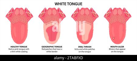 Illustration de la langue blanche, muguet buccal, ulcère buccal et langue géographique Banque D'Images