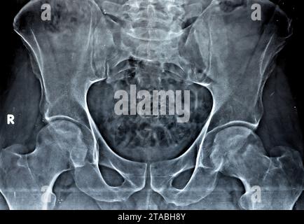 La radiographie simple des deux articulations de la hanche a révélé un léger rétrécissement de l'aspect superolatéral des deux espaces articulaires de la hanche avec sclérose sous-chondrale de l'a opposé Banque D'Images