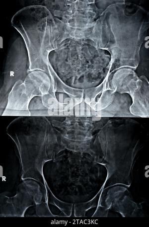 La radiographie simple des deux articulations de la hanche a révélé un léger rétrécissement de l'aspect superolatéral des deux espaces articulaires de la hanche avec sclérose sous-chondrale de l'a opposé Banque D'Images