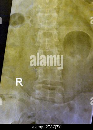 La radiographie simple du rachis lombo-sacré a révélé une légère déformation scoliotique redressée du rachis lombaire, des modifications spondylotiques, une sacro-iliite bilatérale, un narr léger Banque D'Images