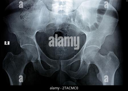 L'examen radiographique numérique des articulations de la hanche révèle un aspect normal des articulations de la hanche, des phléboli pelviens multiples, de la coxa profunda bilatérale, de la spher préservée Banque D'Images