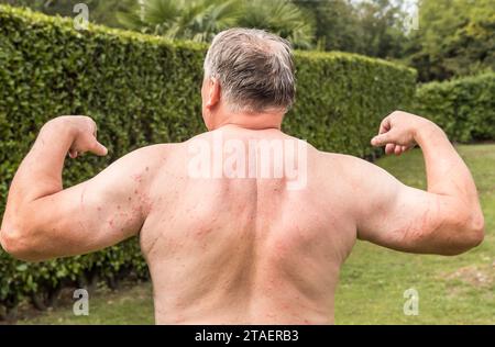 Dos et bras de l'homme avec éruption cutanée, symptômes de démangeaisons, allergie cutanée. Banque D'Images