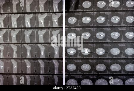 Le Caire, Egypte, octobre 18 2023 : TDM articulation gauche du poignet montrant une fracture récente de fissure à la partie inférieure d'un os du RADIUS gauche, une précédente interne Banque D'Images