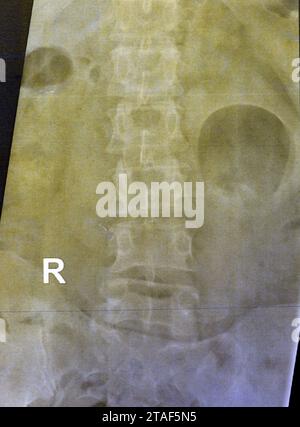 La radiographie simple du rachis lombo-sacré a révélé une légère déformation scoliotique redressée du rachis lombaire, des modifications spondylotiques, une sacro-iliite bilatérale, un narr léger Banque D'Images