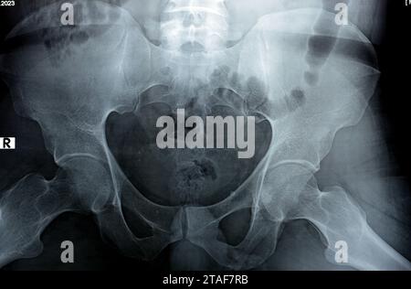 L'examen radiographique numérique des articulations de la hanche révèle un aspect normal des articulations de la hanche, des phléboli pelviens multiples, de la coxa profunda bilatérale, de la spher préservée Banque D'Images