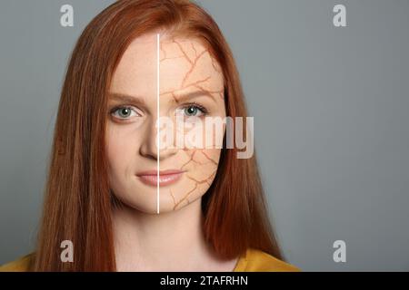 Traitement de la peau sèche. Belle jeune femme avant et après la procédure sur fond gris, collage. Espace pour le texte Banque D'Images