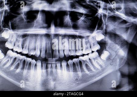 Radiographie panoramique d'une fracture de la mâchoire chez une fille après un traumatisme direct du côté gauche, radiographie dentaire panoramique du haut et du bas Banque D'Images