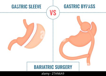 Chirurgie bariatrique, illustration conceptuelle Banque D'Images