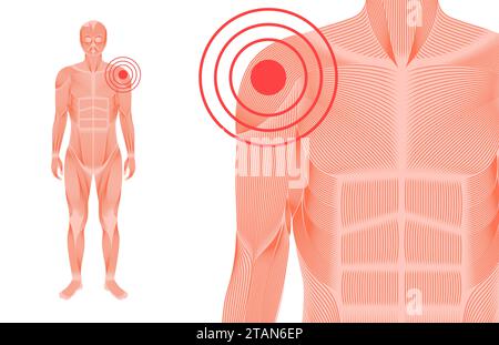 La douleur de l'épaule, illustration conceptuelle Banque D'Images