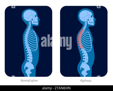 Rachis sain et scoliose, illustration Banque D'Images