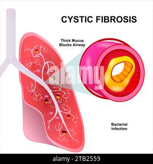 Mucoviscidose illustration de l'infection pulmonaire Banque D'Images