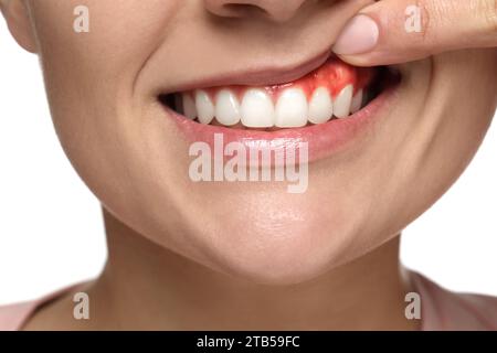 Femme montrant une gencive enflammée sur fond blanc, closeup Banque D'Images