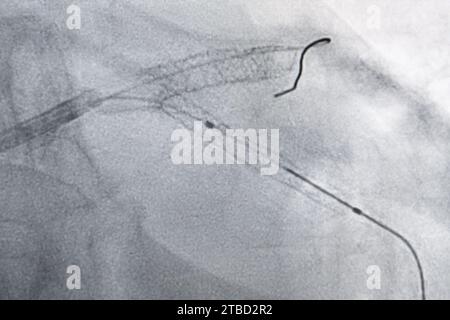 Stuttgart, Allemagne. 10 novembre 2023. La mise en place d'un stent peut être vue sur une image radiographique pendant une chirurgie cardiaque. Crédit : Marijan Murat/dpa/Alamy Live News Banque D'Images