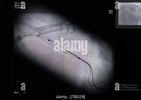 Stuttgart, Allemagne. 10 novembre 2023. La mise en place d'un stent peut être vue sur une image radiographique pendant une chirurgie cardiaque. Crédit : Marijan Murat/dpa/Alamy Live News Banque D'Images