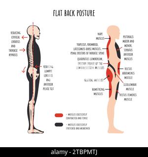 Infographie des troubles posturaux. Posture du dos plat. La vue latérale montre la diminution caractéristique des courbes naturelles de la colonne vertébrale, rotation du bassin, étiré et affaibli, raccourci et dizaines muscles. Vecteur. Illustration de Vecteur