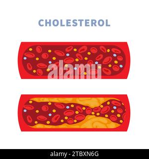 Santé artérielle, illustration conceptuelle Banque D'Images
