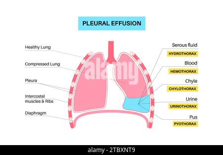 Épanchement pleural, illustration Banque D'Images