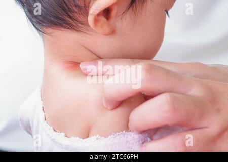 mère appliquant la crème antiallergique au cou de bébé avec éruption cutanée et allergie avec tache rouge causée par piqûre de moustique Banque D'Images