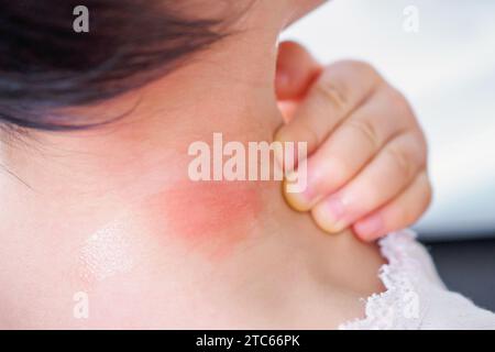 éruption cutanée de bébé et allergie avec tache rouge causée par une piqûre de moustique au cou Banque D'Images