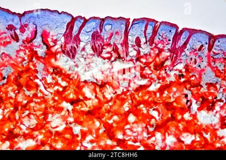 Peau humaine avec gale, produite par un acarien (Sarcoptes scabiei hominis). Microscope optique X50 à 10 cm de large. Banque D'Images