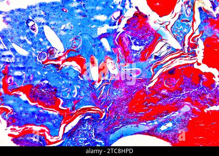 Peau humaine avec gale, produite par un acarien (Sarcoptes scabiei hominis). Microscope optique X150 à 10 cm de large. Banque D'Images