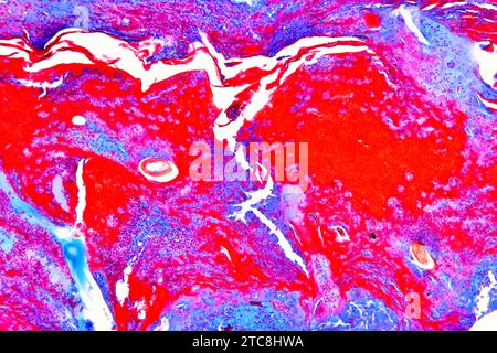 Peau humaine avec gale, produite par un acarien (Sarcoptes scabiei hominis). Microscope optique X150 à 10 cm de large. Banque D'Images