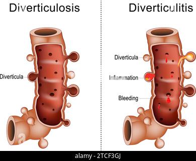 Différence entre diverticulite et diverticulose colique. Gros plan d'une partie du gros intestin avec diverticules, saignements et inflammation, Hum Illustration de Vecteur