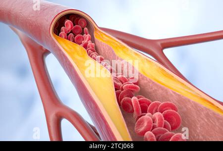 Athérosclérose. Cholestérol dans les vaisseaux sanguins. plaque athérosclérotique, cellules sanguines, pression artérielle. Rendu 3D. Illustration 3D. Banque D'Images