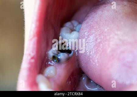 une dent détruite par la carie en gros plan. Dents d'enfant malsaines avec plaque noire. Dents manquantes. La bouche de l'enfant avec une dent pourrie de lait. a lâche f Banque D'Images