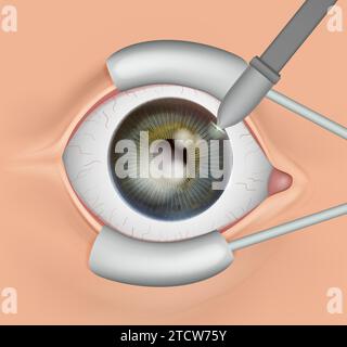 Le procédé de chirurgie oculaire. Anatomie de l'oeil Illustration de Vecteur