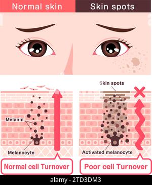 Illustration vectorielle de la façon dont les taches cutanées (hyperpigmentation) sont créées. Illustration de Vecteur