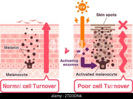 Illustration vectorielle de la façon dont les taches cutanées (hyperpigmentation) sont créées. Illustration de Vecteur