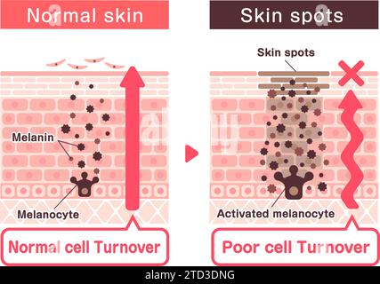 Illustration vectorielle de la façon dont les taches cutanées (hyperpigmentation) sont créées. Illustration de Vecteur