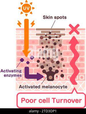 Illustration vectorielle de la façon dont les taches cutanées (hyperpigmentation) sont créées. Illustration de Vecteur