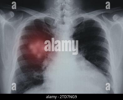 Cancer du poumon. Image radiologique des poumons d'un patient à la maladie pulmonaire. Banque D'Images