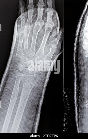 Réduction de fracture colles d'une vieille femelle, un type de fracture de l'avant-bras distal, l'extrémité cassée du RADIUS est pliée vers l'arrière, à la suite d'un Banque D'Images