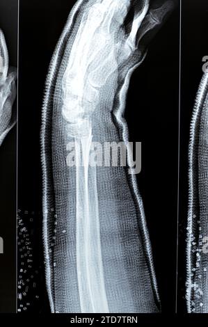 Réduction de fracture colles d'une vieille femelle, un type de fracture de l'avant-bras distal, l'extrémité cassée du RADIUS est pliée vers l'arrière, à la suite d'un Banque D'Images