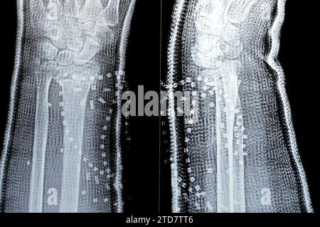 Colles fracture cicatrisation d'une vieille femelle, un type de fracture de l'avant-bras distal, l'extrémité cassée du RADIUS est pliée vers l'arrière, à la suite d'un f Banque D'Images