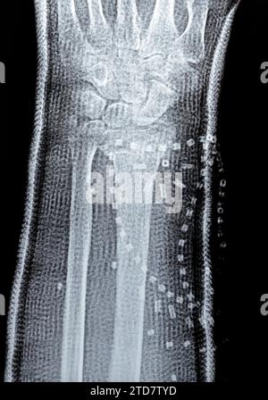 Colles fracture cicatrisation d'une vieille femelle, un type de fracture de l'avant-bras distal, l'extrémité cassée du RADIUS est pliée vers l'arrière, à la suite d'un f Banque D'Images