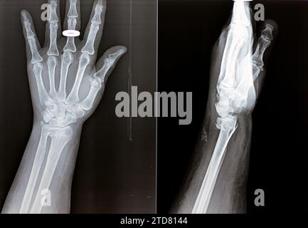 Fracture de colles d'une vieille femelle, un type de fracture de l'avant-bras distal dans lequel l'extrémité cassée du RADIUS est pliée vers l'arrière, à la suite d'un Banque D'Images