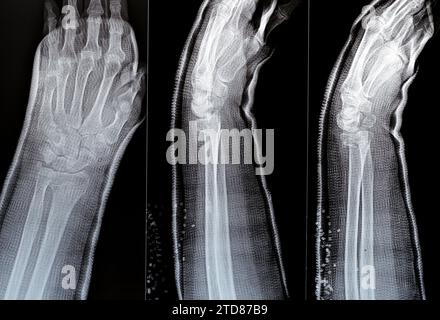 Réduction de fracture colles d'une vieille femelle, un type de fracture de l'avant-bras distal, l'extrémité cassée du RADIUS est pliée vers l'arrière, à la suite d'un Banque D'Images