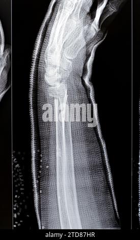 Réduction de fracture colles d'une vieille femelle, un type de fracture de l'avant-bras distal, l'extrémité cassée du RADIUS est pliée vers l'arrière, à la suite d'un Banque D'Images