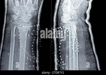 Colles fracture cicatrisation d'une vieille femelle, un type de fracture de l'avant-bras distal, l'extrémité cassée du RADIUS est pliée vers l'arrière, à la suite d'un f Banque D'Images